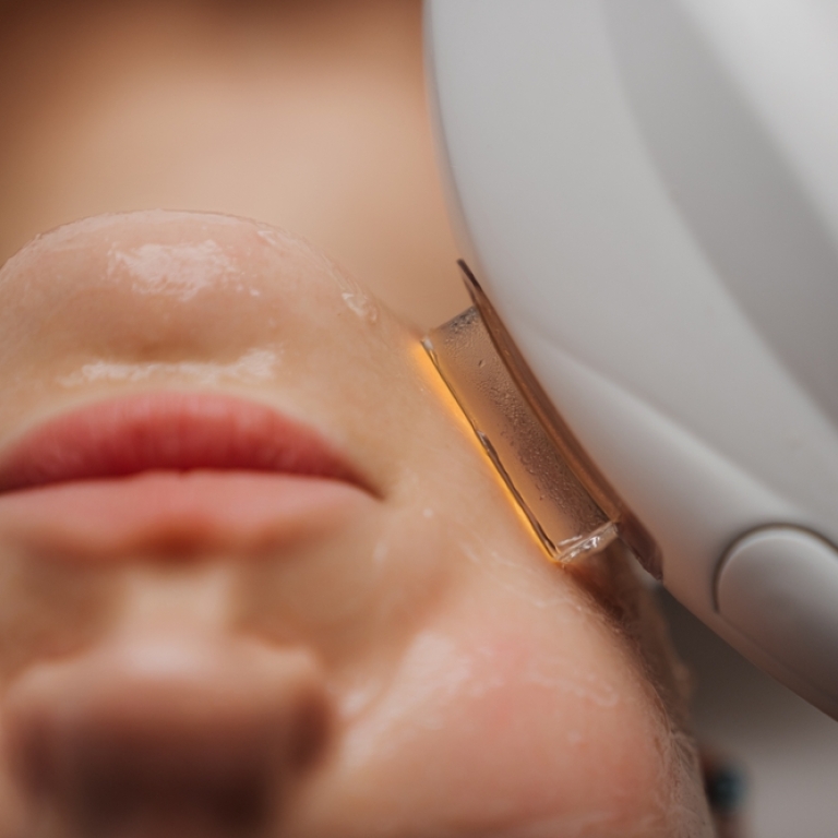 facial laser treatment