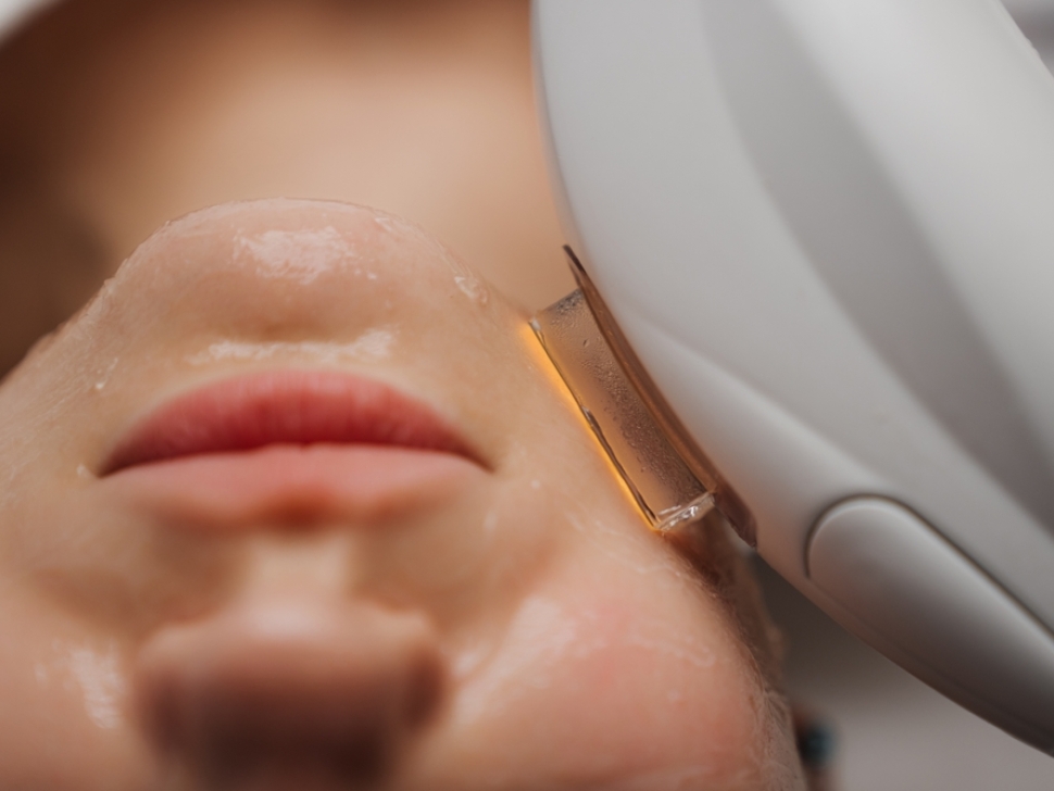 facial laser treatment